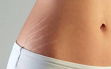 رفع ترک های شکم در بارداری