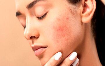 بهترین روش‌های طبیعی برای درمان آکنه