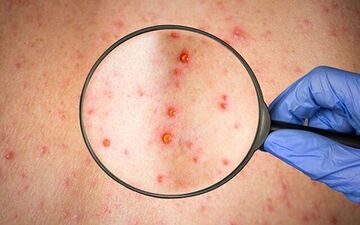 
آمار مبتلایان به آبله میمونی در جهان
