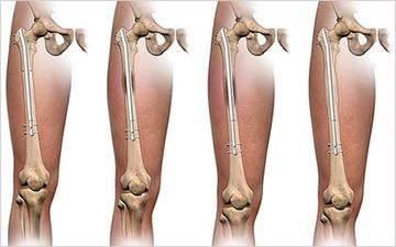 جراحی افزایش قد: آیا خطرناک است؟