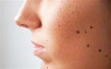 از بین بردن خال صورت بدون جراحی و هزینه‌‌| روش های خانگی برای از بین بردن خال های صور‌ت! 
